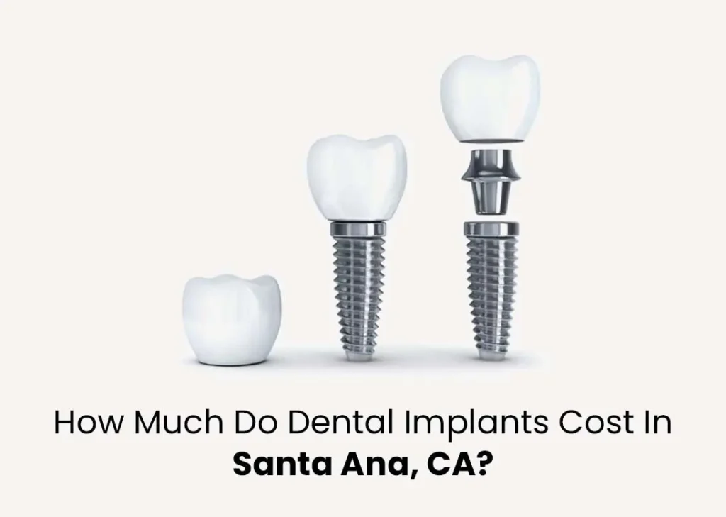 How Much Do Dental Implants Cost in Santa Ana, CA