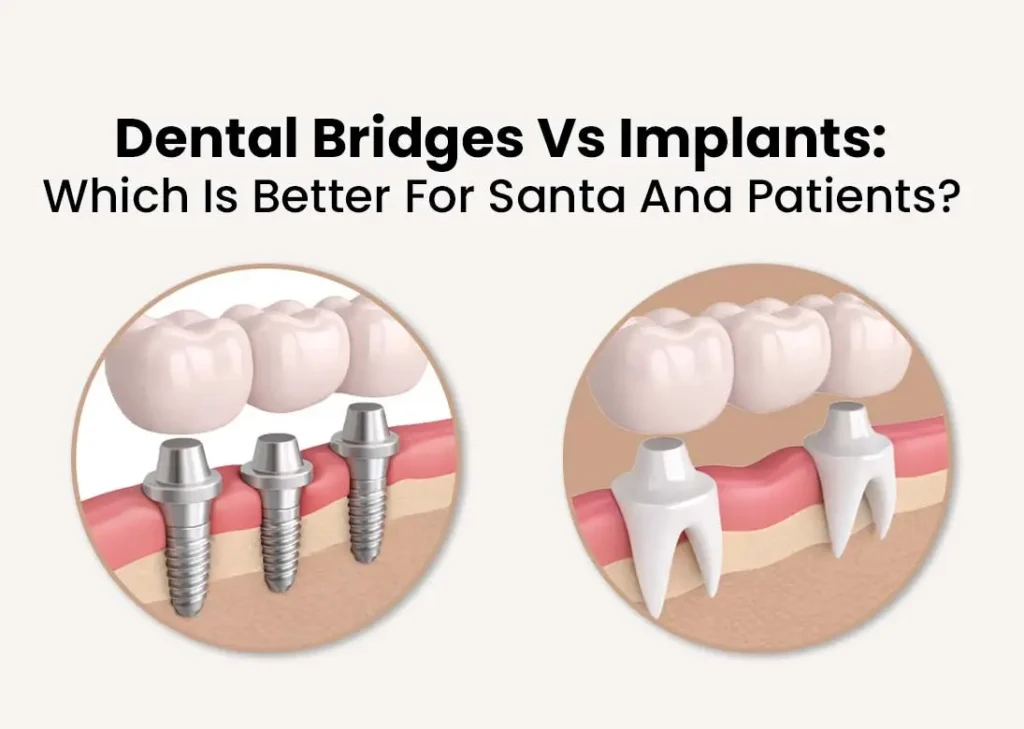 Dental bridges vs implant, santa ana