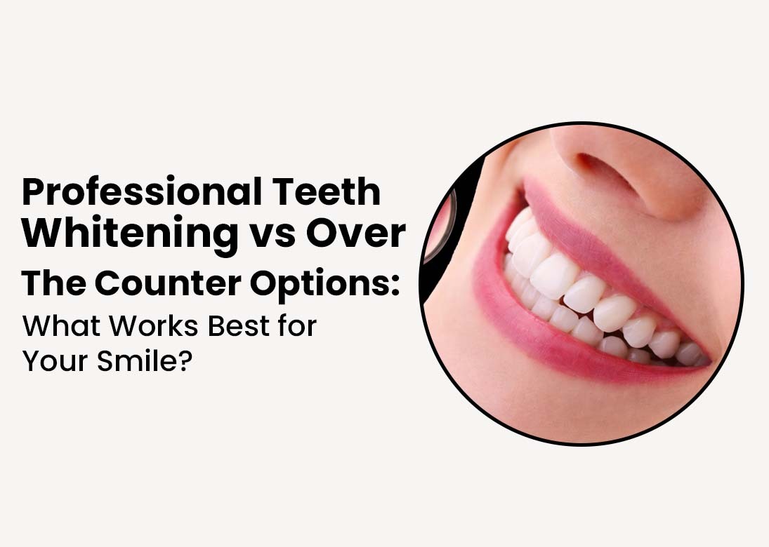 Professional teeth whitening VS over the Counter Option
