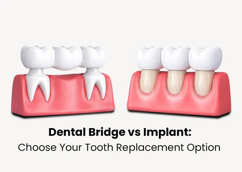 Dental Bridge vs Implant Choose Your Tooth Replacement Option