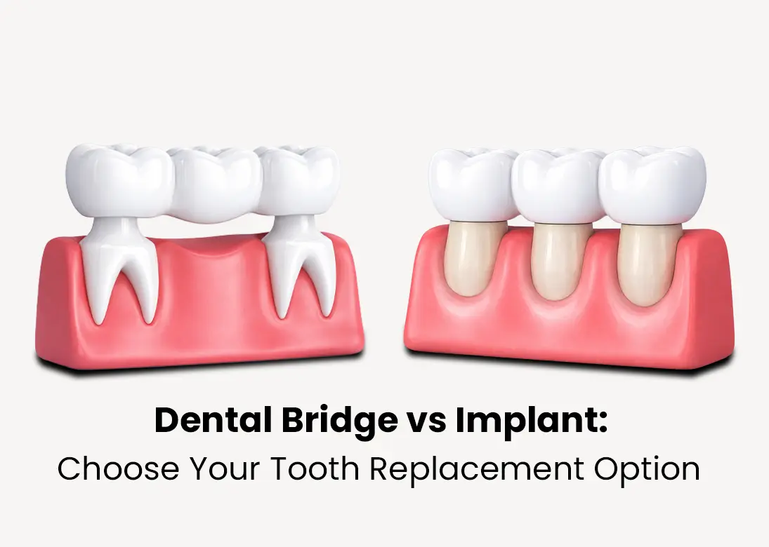 Dental Bridge vs Implant Choose Your Tooth Replacement Option