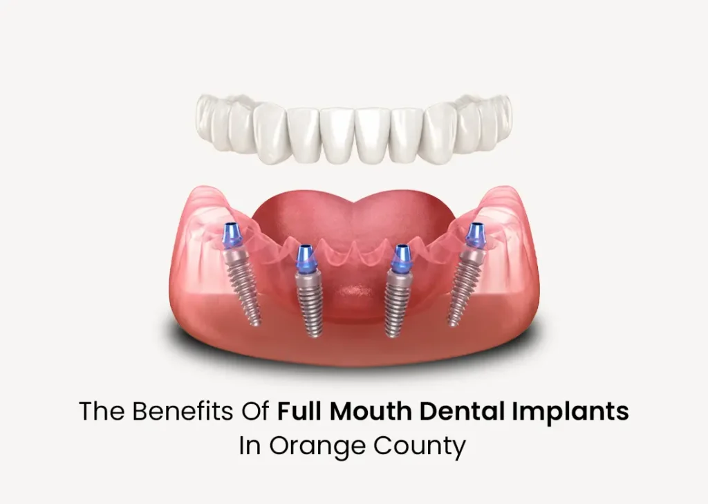 The Benefits of Full Mouth Dental Implants in Orange County
